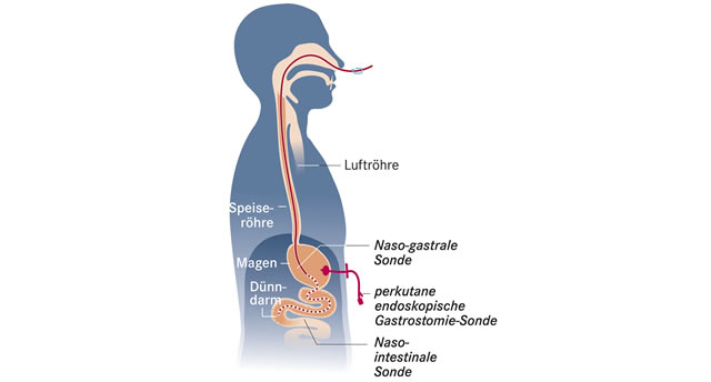Sondenernährung (Schematische Darstellung)