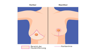 An diesen Stellen werden bei einer Brust-Verkleinerung Schnitte durchgeführt.