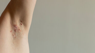 Akne inversa (Hidradenitis suppurativa) zeigt sich oft an behaarten großen Hautfalten, zum Beispiel in den Achseln. Es bilden sich knotenartige Schwellungen, die bei Berührung schmerzhaft sein können.