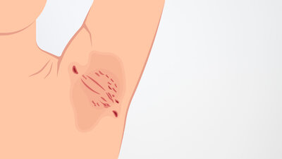 Akne inversa (Hidradenitis suppurativa) zeigt sich oft an behaarten großen Hautfalten, zum Beispiel in den Achseln. Es bilden sich knotenartige Schwellungen, die bei Berührung schmerzhaft sein können. 