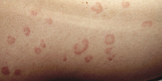 Auf der Haut einer Erkrankten ist ein kreisrunder roter Ausschlag zu sehen.