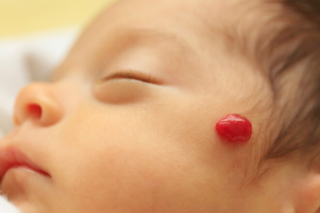Blutschwämmchen Blutschwamm Baby Kind Close Makro Kopf Nahaufnahme