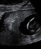 Ultraschallbild während einer Chorionzottenbiopsie. Die Nadel ist schemenhaft zu erkennen und verläuft von schräg oben rechts zur Bildmitte