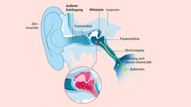 Mittelohrentzündung (Otitis media): Typischerweise wandern Viren oder Bakterien über den Rachen durch die sogenannte Ohrtrompete in das Mittelohr. In diesem Hohlraum, auch Paukenhöhle genannt, vermehren sich die Erreger und als Reaktion schwellen die Schleimhäute an. Die Verbindung zum Rachen ist plötzlich dicht, das Mittelohr wird nicht mehr belüftet. Denn auf der anderen Seite verschließt das Trommelfell das Ohr. Es entsteht Unterdruck, der starke Schmerzen auslöst. Geht die Ohrtrompete nicht wieder auf, können sich die Erreger noch weiter vermehren, die Entzündung kann schlimmer werden und vereitern.