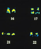 Trisomie 21: Im Chromosomensatz sind auf der Stelle 21 drei statt zwei Chromosomen zu sehen