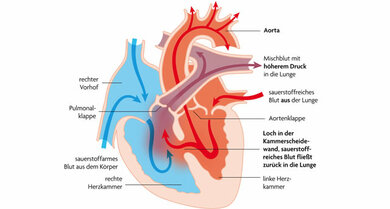 Defekte Herzscheidewand: Bei einem gesunden Herzen ist die linke von der rechten Herzkammer und damit der Körper- vom Lungenkreislauf durch die Herzscheidewand getrennt. Bei einem Ventrikelseptumdefekt klaffen in ihr ein oder mehrere Löcher. Dadurch fließt sauerstoffreiches Blut von der Lunge direkt wieder in die Lunge, anstatt über die Aorta in den unteren und oberen Körper gepumpt zu werden.