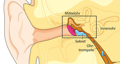 Wenig Durchzug: Ist die Belüftung des Mittelohrs durch die Ohrtrompete gestört, sammelt sich dort Flüssigkeit. Ein Paukenröhrchen schafft dann oft Abhilfe
