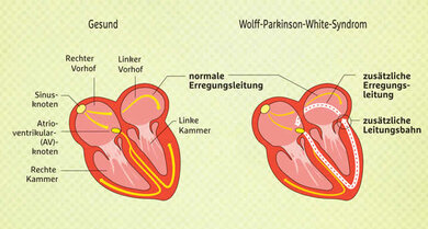 Beim gesunden Herzen nimmt die elektrische Erregung nur einen Weg: vom Sinusknoten über den AV-Knoten in die Herzkammern. Diese ziehen sich regelmäßig zusammen, das Blut wird in die Adern gepumpt. Der Herzschlag ist gleichmäßig.  Beim WPW-Syndrom gibt es eine zusätzliche Leitungsbahn. Diese bewirkt, dass es zu einem Kurz­schluss (weißer Kreis) kommt. Das führt zu einem Anfall von Herzrasen. Der Puls ist deutlich erhöht.