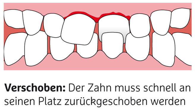 Infografik zum Thema Zahnunfall