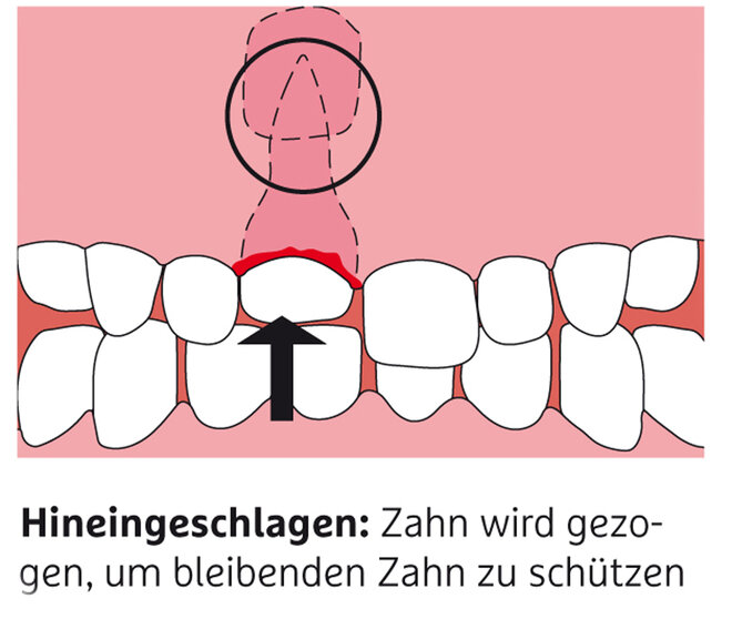 Infografik zum Thema Zahnunfall