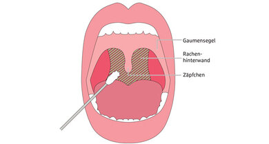 Den Mund weit öffnen und die Zunge herausstrecken &#x96; das ermöglicht dem Arzt den Rachenabstrich für den PCR-Test
