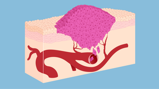 Krebs kann wachsen und Anschluss an die Blutbahn finden.