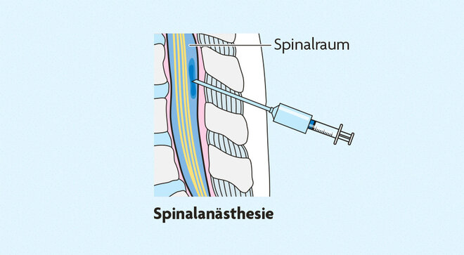 Infografik Schmerzmittel Spinalanästhesie