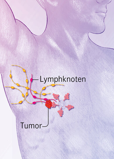 Stadium 2: Der Krebs befällt die umliegenden Lymphknoten.