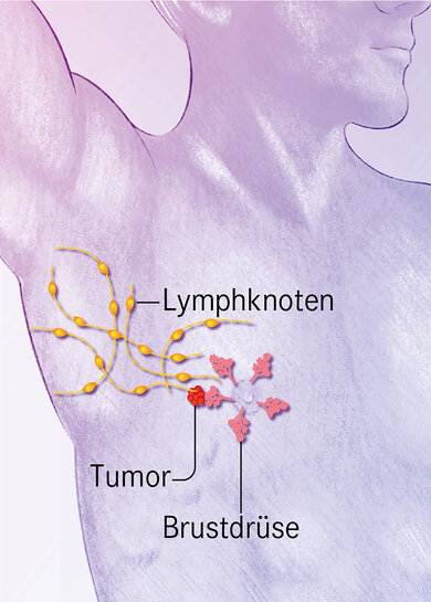 Es gibt vier Krebsstadien beim männlichen Brustkrebs. Stadium 1: Der Tumor bildet sich in einer Brustdrüse.