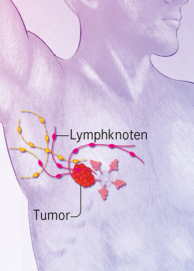 Krebsstadium 3: Der Tumor wächst und ist größer als fünf Zentimeter.