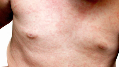 Drei-Tage-Fieber: Der rote Ausschlag tritt zunächst auf Brust, Bauch und Rücken auf. Nach zwei bis drei Tagen klingt er meist wieder ab.
