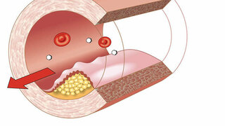 Arterienverkalkung in den Blutgefäßen