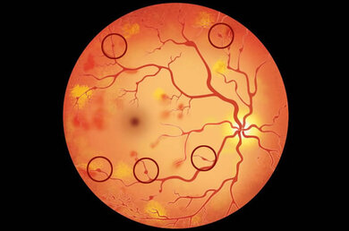 Mikroaneurysmen im Auge (zum Beispiel an den eingekreisten Stellen)