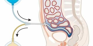 Peritonealdialyse: Über den Katheter erhält der Patient die Lösung in die Bauchhöhle.