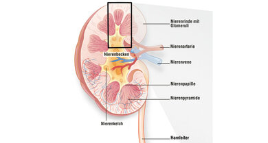 Eine Nierenbeckenentzündung kann durch Bakterien ausgelöst werden, die über den Harnleiter in die Niere aufsteigen (ein Klick auf die Lupe zeigt die komplette Grafik)