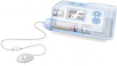 Darstellung einer Insulinpumpe: Ein Katheter verbindet das Hauptgerät mit der Kanüle (links unten)