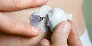 Zuckermessung: Sensor im Bauchfett