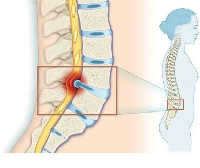 Äußerst schmerzhaft: Der Bandscheiben-Gallertkern (blau) drückt auf die Nervenwurzeln (gelb)
