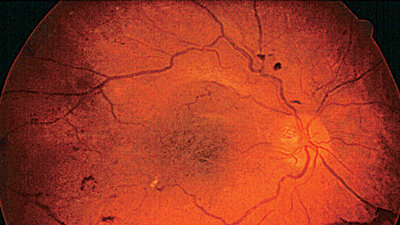 Augenhintergrund mit Retinopathie vor Lasertherapie