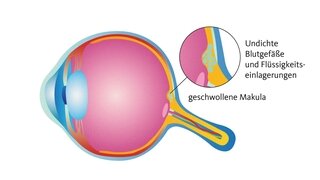 Bei einem Makulaödem ist die Stelle des schärfsten Sehens betroffen.