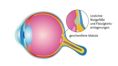 Bei einem Makulaödem ist die Stelle des schärfsten Sehens betroffen.