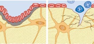 Osteoklasten und Osteoblasten bauen den Knochen um
