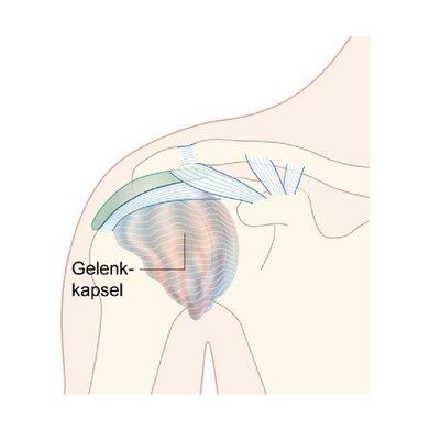 Frozen Shoulder: Im Verlauf der Erkrankung verhärtet die Gelenkkapsel und das Schultergelenk versteift