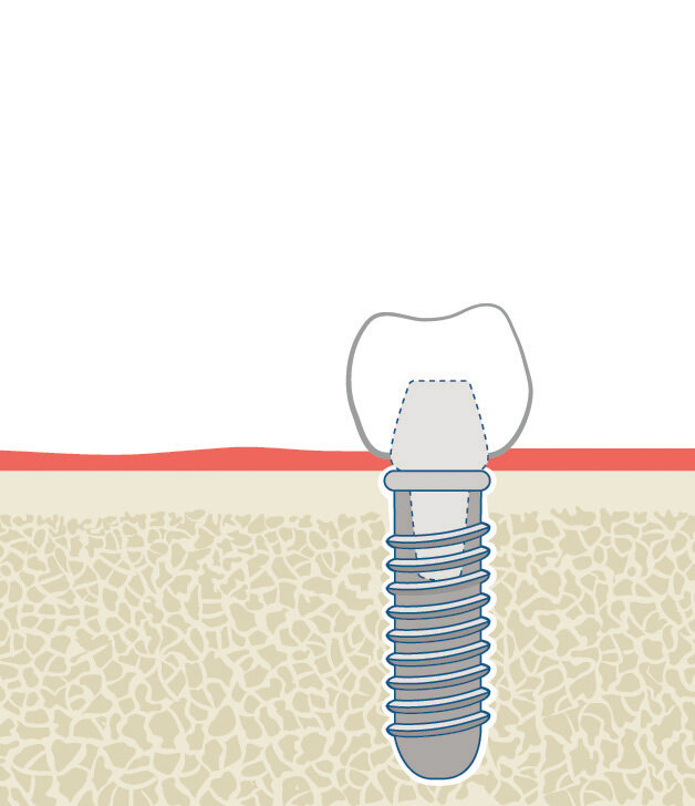 Infografik Zahn Zähne Implantat 