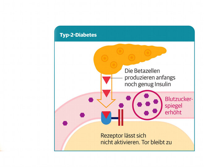Infografik Diabetes Typ 2