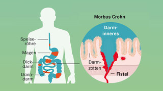 Das passiert bei Morbus Crohn:  Tiefe Entzündungen in allen Schichten der Schleimhaut führen in Dünn- und Dickdarm, oft sogar im ganzen Verdauungstrakt zu Entzündungen und Verengungen (Stenosen).