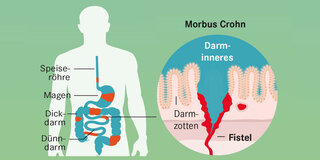 Das passiert bei Morbus Crohn:  Tiefe Entzündungen in allen Schichten der Schleimhaut führen in Dünn- und Dickdarm, oft sogar im ganzen Verdauungstrakt zu Entzündungen und Verengungen (Stenosen).
