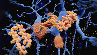 Im Gehirn von Alzheimer-Patienten befinden sich sogenannte Amyloid-Plaques. Das Medikament Donanemab reduziert diese.