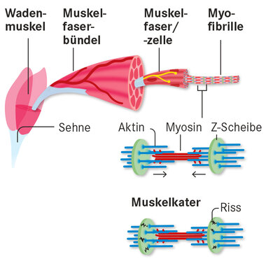Die Grafik zeigt, was bei einem Muskelkater im Muskel passiert