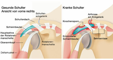 Platzmangel in der Schulter: Für das schmerzhafte Impingment gibt es viele Gründe. Sehnenschäden und Entzündungen sind die Folge