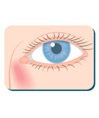 Augensalben helfen bei geschwollenem Tränensack