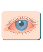 Ein rotes Auge kann auf Allergien oder Infektionen hinweisen