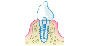 Zahn Implantat Grafik Illustration 