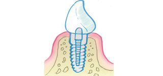 Zahn Implantat Grafik Illustration