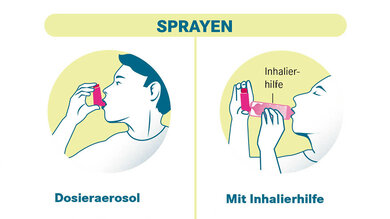 Beim Sprayen wird in der Regel entweder das Dosieraerosol direkt oder mit einer Inhalierhilfe verwendet.