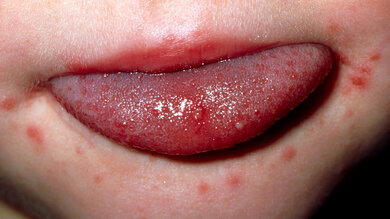 Bläschen auf der Zunge und Ausschlag um den Mund bei Hand-Fuß-Mund-Krankheit.