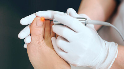 Eine Nagelpilzentfernung mittels Laserstrahlen kann lohnen - allerdings nur in Kombination mit Medikamenten oder Lack.