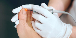Eine Nagelpilzentfernung mittels Laserstrahlen kann lohnen - allerdings nur in Kombination mit Medikamenten oder Lack.