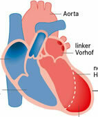 Beim Broken-Heart-Syndrom erinnert die Form der linken Herzkammer an einen Krug zum Tintenfischfangen (Lupe anklicken)