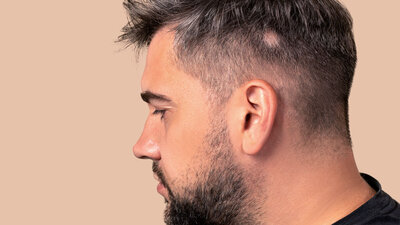Runde kahle Stellen im Kopfhaar sind typisch für kreisrunden Haarausfall (Alopecia areata).